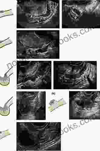 How To Perform Ultrasonography In Endometriosis